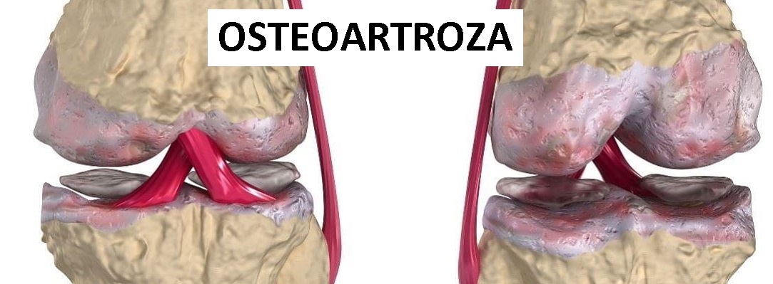 osteoartrosis_knee1083